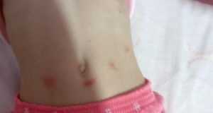 Los políticos discuten por las pulgas, mientras los niños afectados sufren las consecuencias.